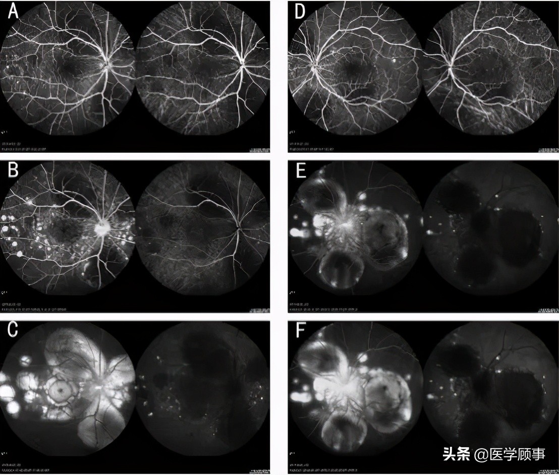 小柳原田综合征需要配眼镜吗,小柳原田综合征是罕见病吗