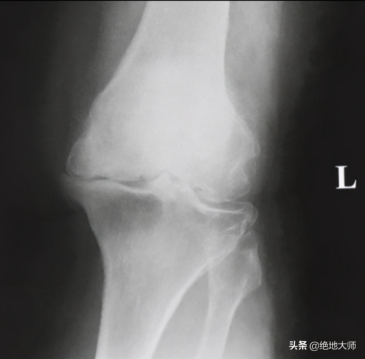 非创伤性膝关节疼痛的评估和神经调控康复治疗