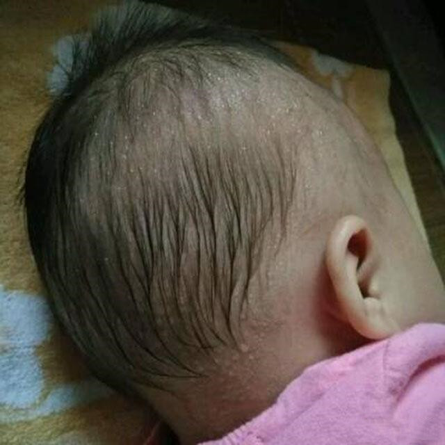 小孩子爱出虚汗需要补锌吗,宝宝出虚汗是缺锌还是缺钙