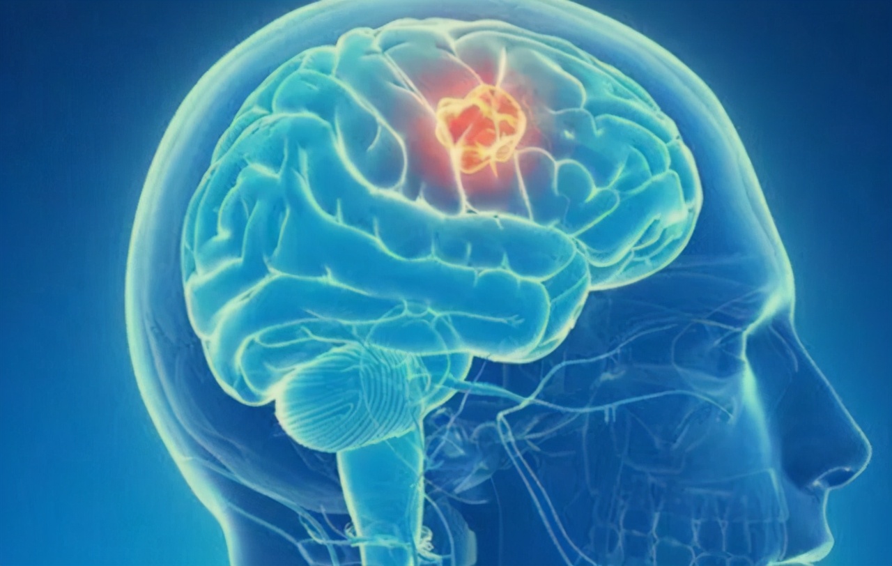 得了脑胶质瘤是不是就完了,得了脑胶质瘤就只有死路一条吗