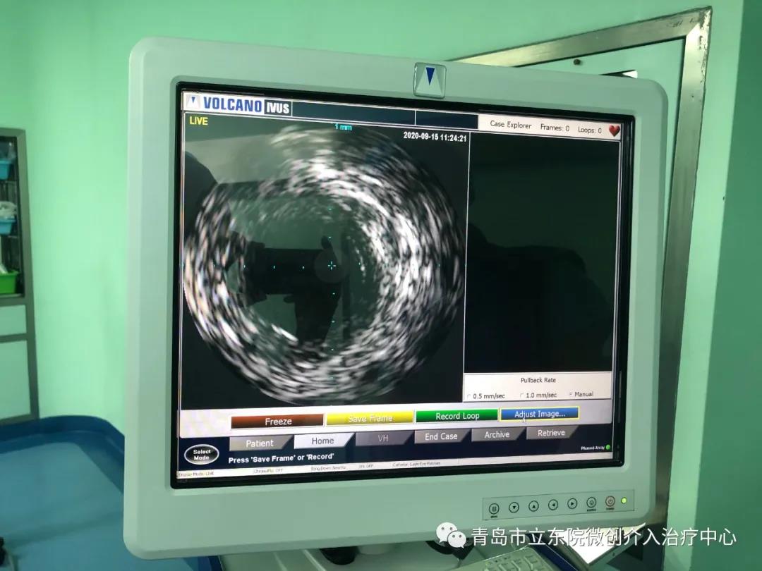 下肢动脉闭塞怎么介入治疗,下肢动脉闭塞介入手术多久能见效