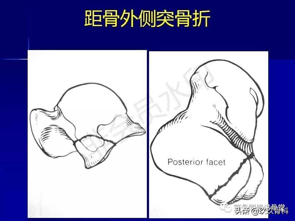 距骨骨折的治疗原则,距骨骨折如何调理