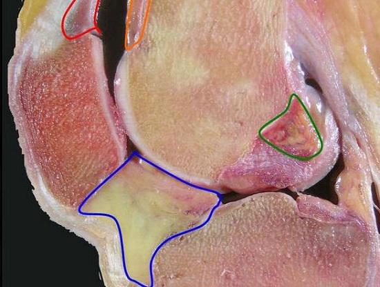 膝关节退化保守治疗,膝关节手术治疗和保守治疗