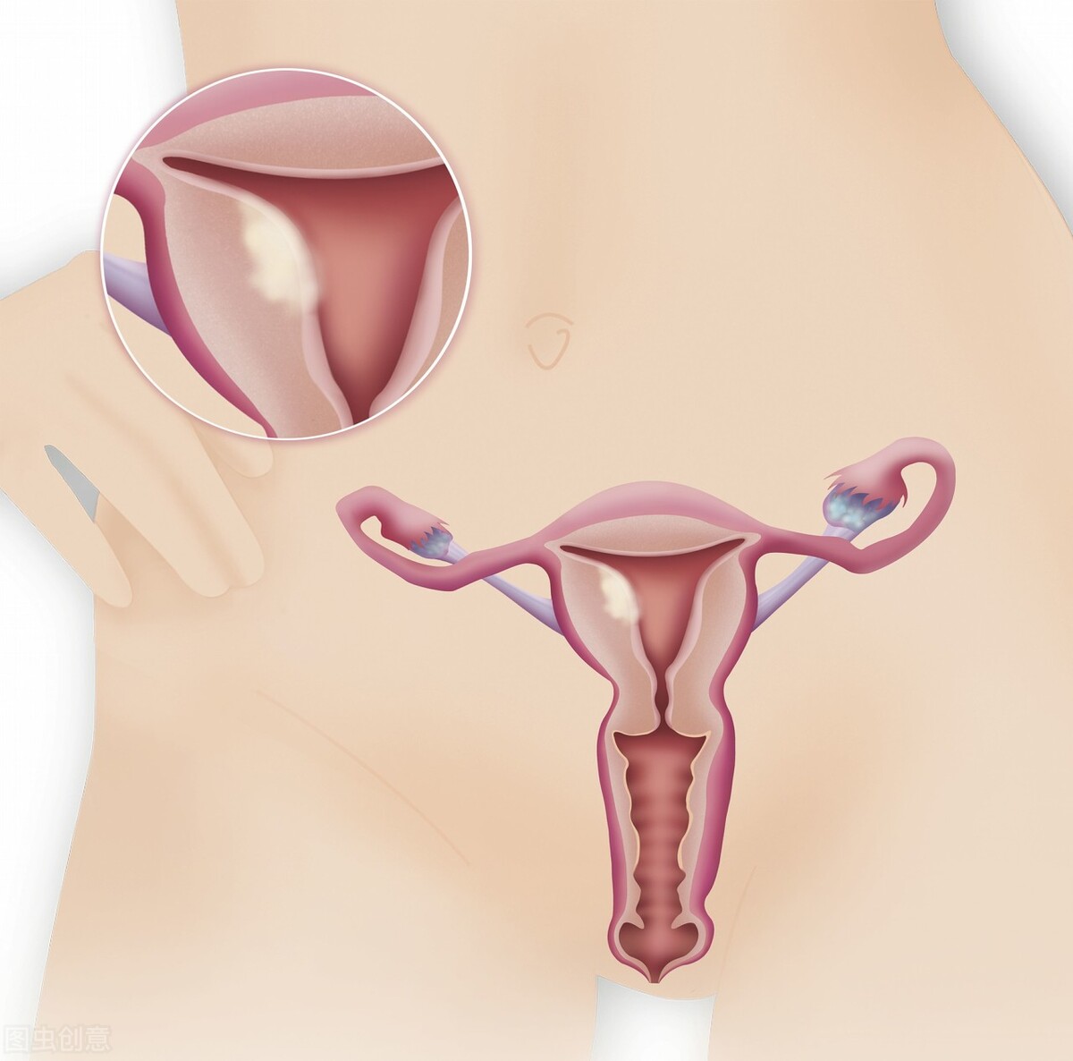 子宫摘除后对夫妻有影响吗,子宫完全摘除影响夫妻关系吗