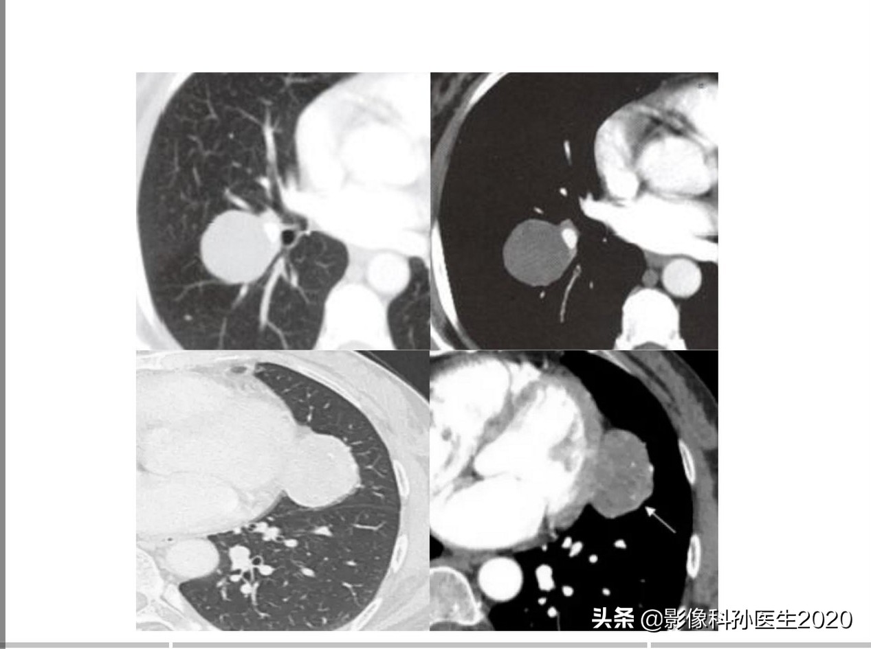 肌纤维母细胞瘤扩切能切干净吗,肌纤维母细胞瘤最好的治疗方法