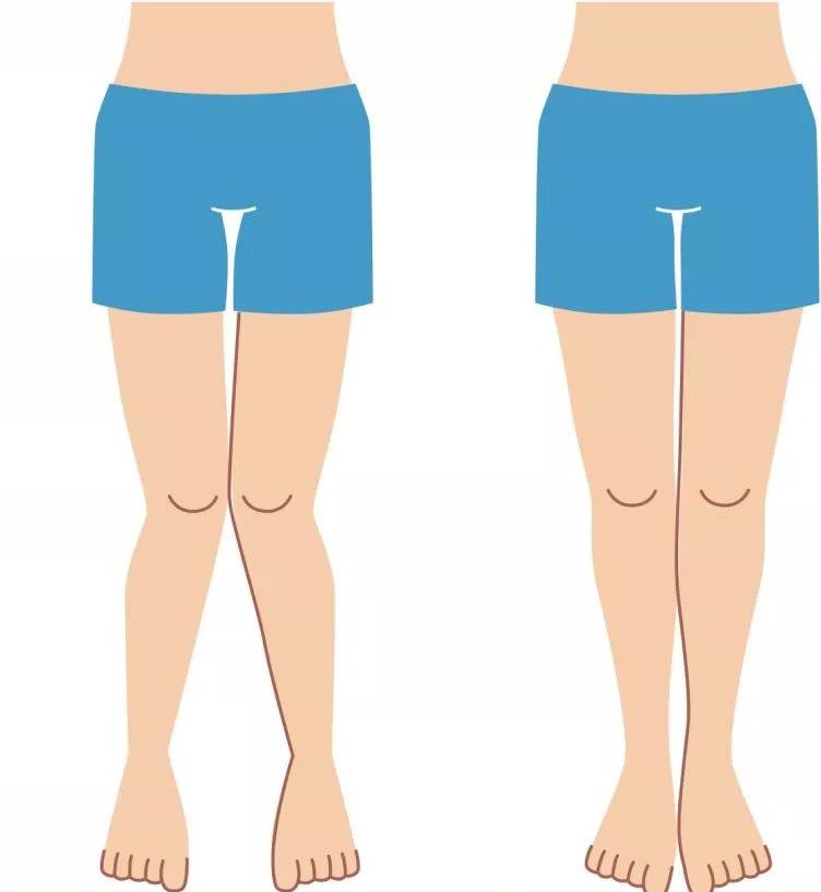 深蹲时膝盖内扣怎么矫正,深蹲膝盖内扣是什么意思