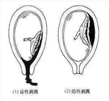 怎样解决孕期出血,孕期出血如何清理外阴