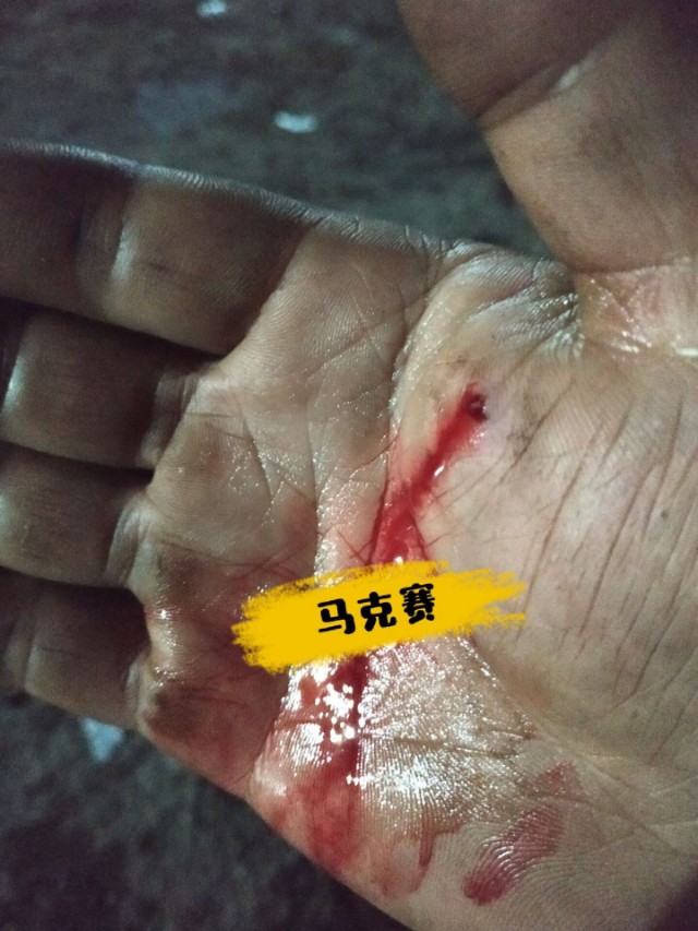 手受伤后，附近血管感觉有些堵塞，摸起来有个小包，这是怎么回事