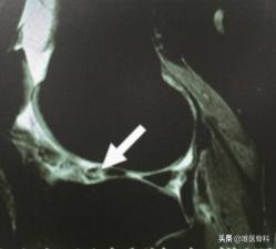 半月板科普小知识,半月板一二三度损伤报告
