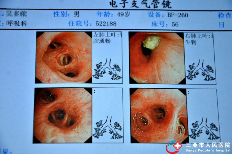 新技术作内核精诚服务患者——三亚市人民医院呼吸内科医疗团队成功开展我省首例支气管镜下冷冻活检术