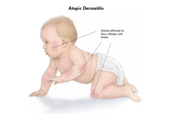 湿疹为何不痒,湿疹不疼不痒怎么治疗和根除