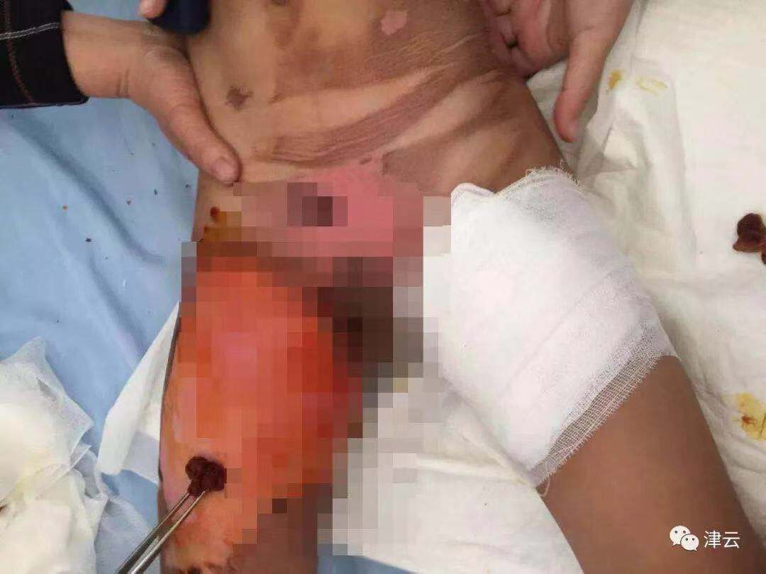 开水烫*体下**灌消毒液残忍的女人对待继子你怎能下得去手?