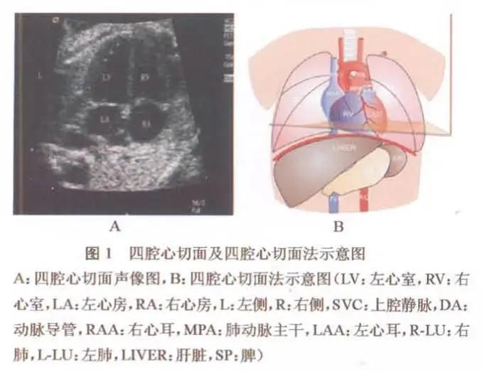 干货分享丨胎儿心脏畸形产前超声筛查与诊断策略