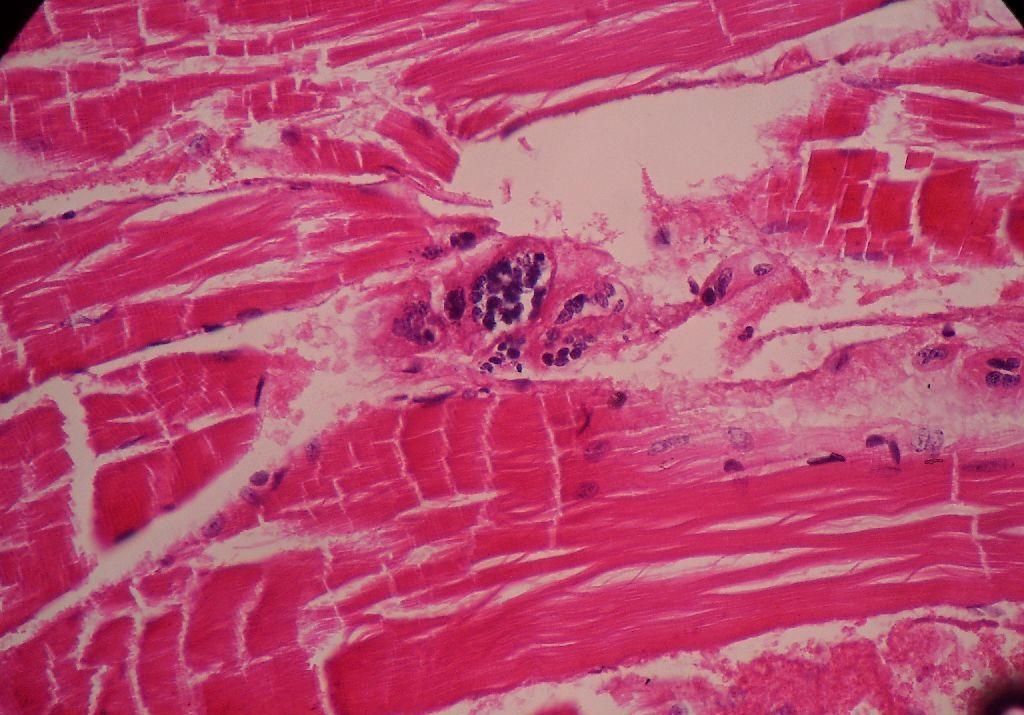 黏液表皮样癌是一种恶性肿瘤，侵犯面神经可引起腮腺的面神经麻痹