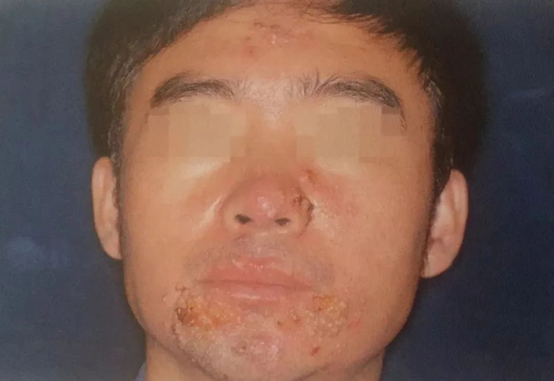 前胸后背长痘痘是毛囊炎吗,前胸后背很容易长痘痘中医治疗