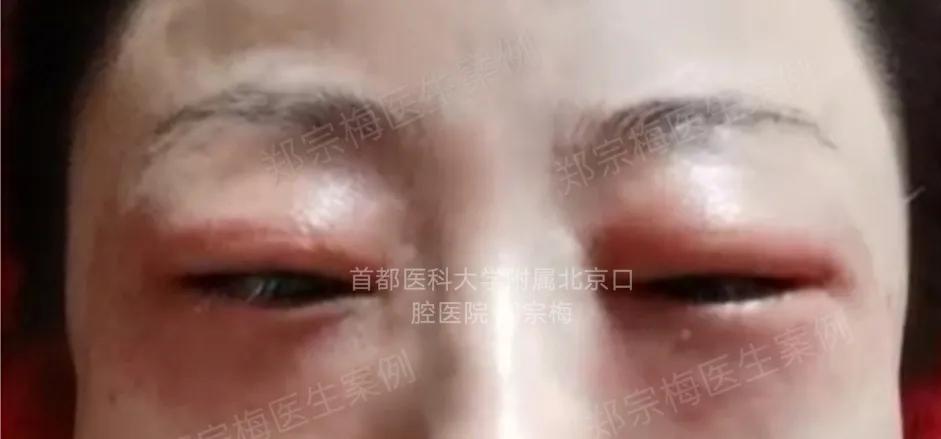 fotona4d有效果吗,fotona4d做完前后对比