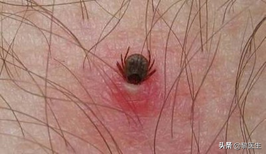被蜱虫咬了后进icu多久可以恢复,男子被蜱虫咬后进了icu