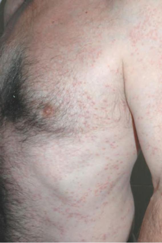 结节病关节痛眼睛模糊,结节病引起的关节炎