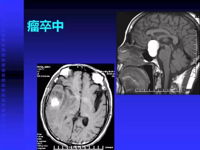 头颅mri读片视频教程,颅脑mri读片入门教程视频讲解全集