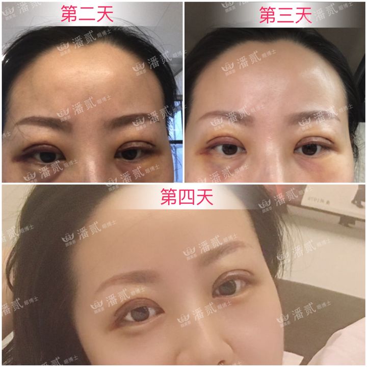 原来双眼皮不好看有必要继续割吗,割双眼皮是不是越修复越难看