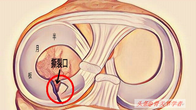 磁共振图片讲解半月板损伤的程度,磁共振半月板损伤严重