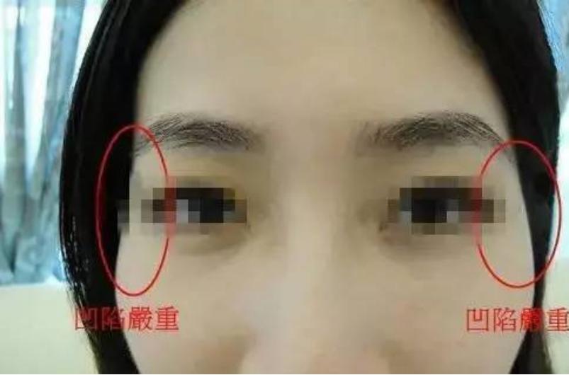 太阳穴凹陷自体脂肪填充怎么样,太阳穴凹陷显凶吗