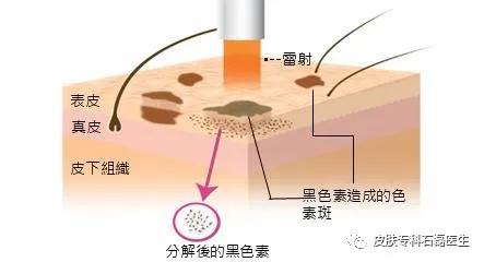 去除淡褐斑的小妙招,去除斑点暗黄修复肌肤