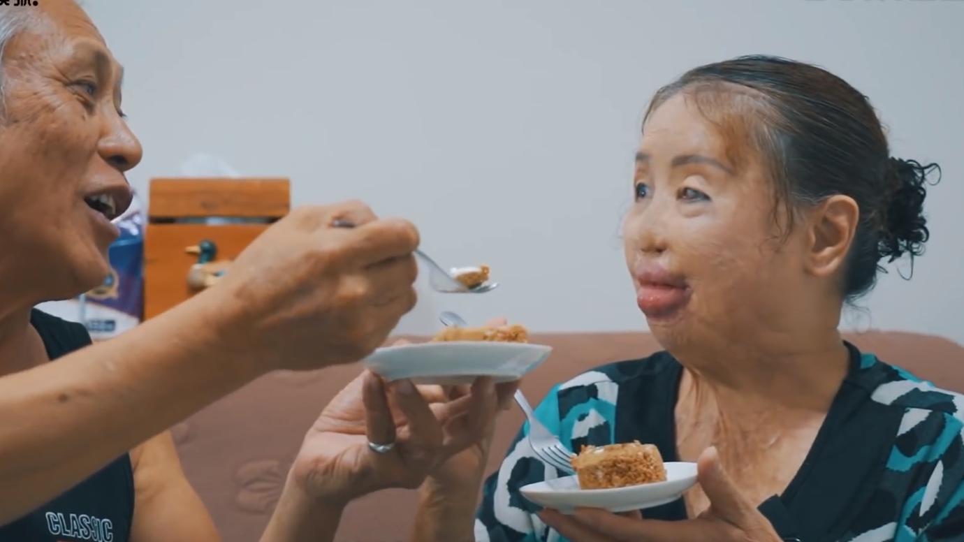 20岁小伙被重度烧伤七年后续,20岁严重烧伤毁容