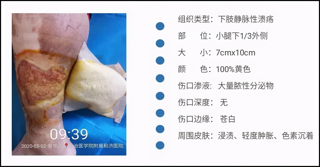 和济医院为73岁患者治愈“老烂腿”