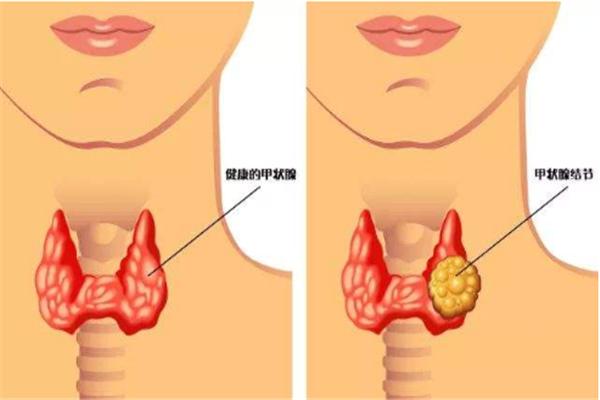 老中医对甲状腺患者说的话，建议耐心观看