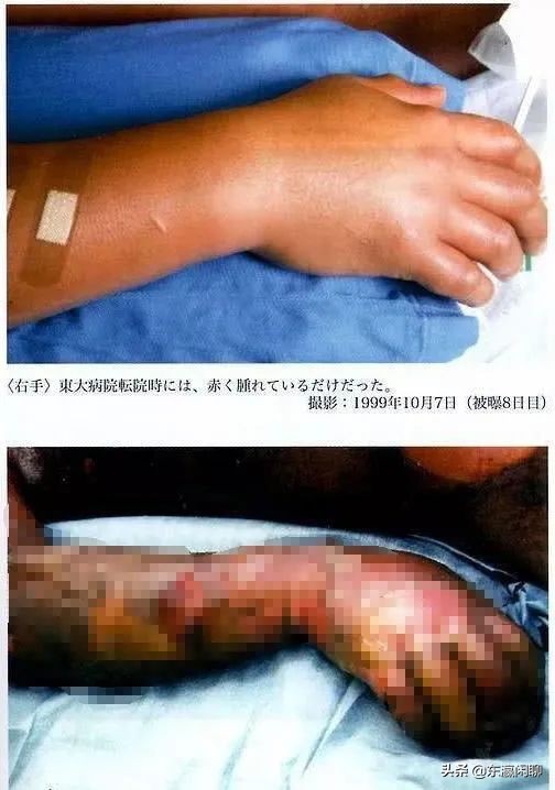 遭遇核辐射死得最惨的人,日本被核辐射致死的人