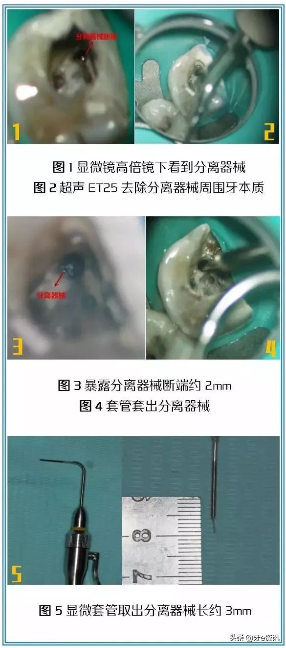 根管治疗断针算不良事件吗,根管治疗断针属于医疗事故吗