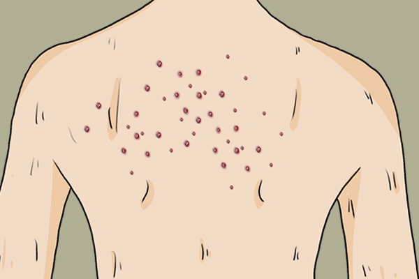 女人脖子后面的富贵包是什么原因,脖子后面的富贵包什么方法能去掉