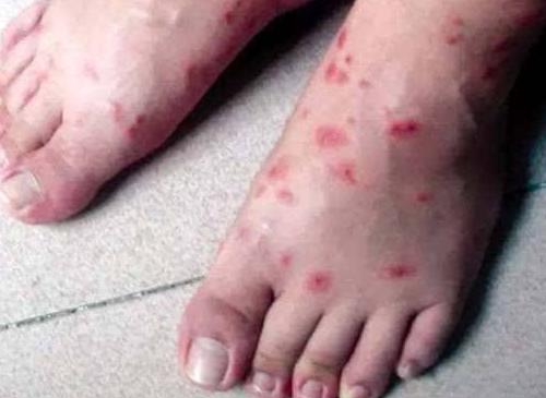 被红火蚁咬伤怎么治疗,男子被红火蚁咬伤民警紧急送医