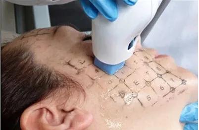 医美收毛孔价格表,医美收毛孔效果