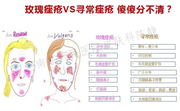 过敏脸上身上全是红痘痘,脸红就是玫瑰痤疮吗