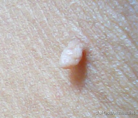 脖子上长皮赘激光后怎么防止复发,脖子上长了小肉粒皮赘擦什么药膏