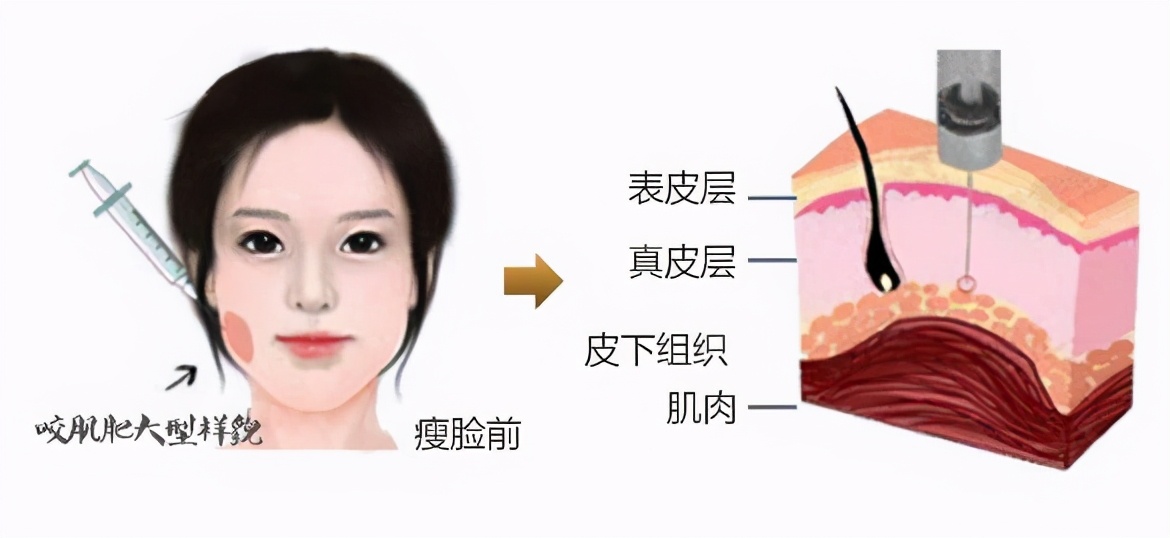 揭秘微整形之瘦脸整形,如何微整形改变大小脸