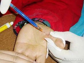 怎么用键盘不容易得腱鞘炎,键盘侠腱鞘炎