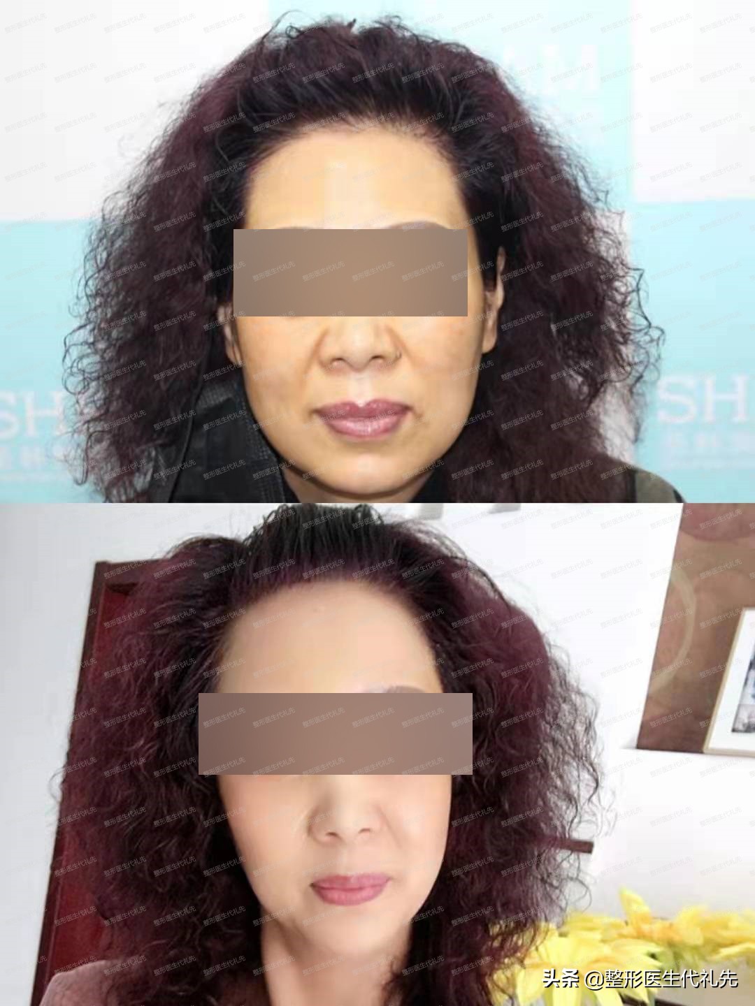 现在最流行的面部提升是什么项目,目前最先进效果最好的面部提升