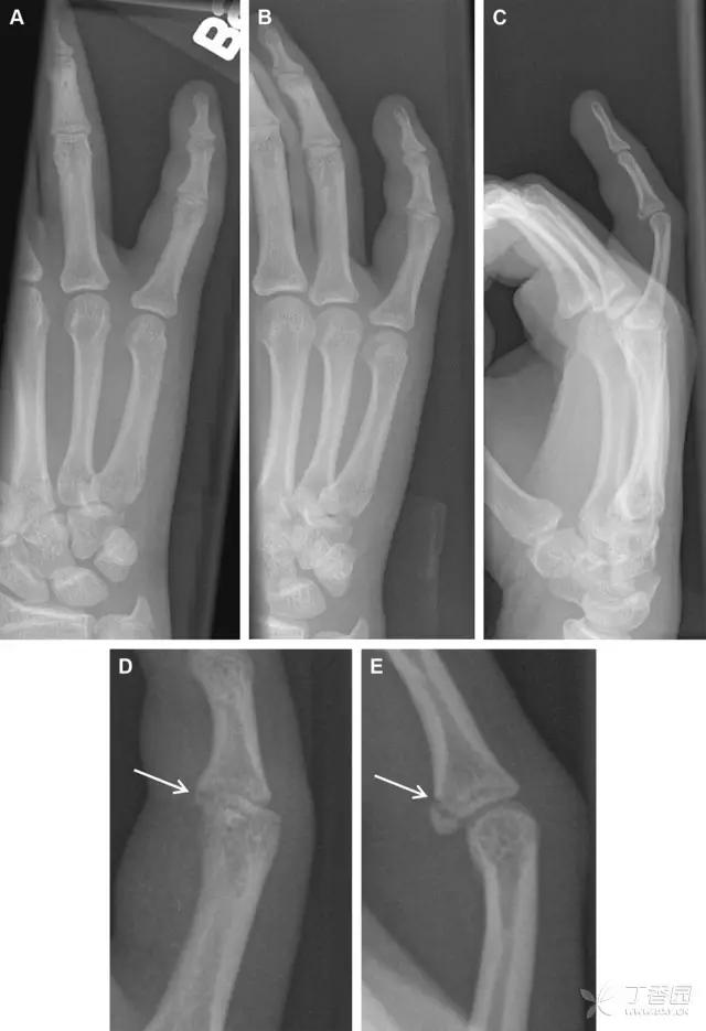 值夜班急救措施,放射科容易漏诊的骨折