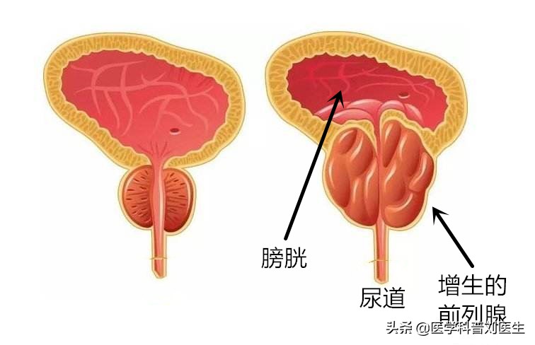 如何关注男性健康,疏通尿管的最好方法