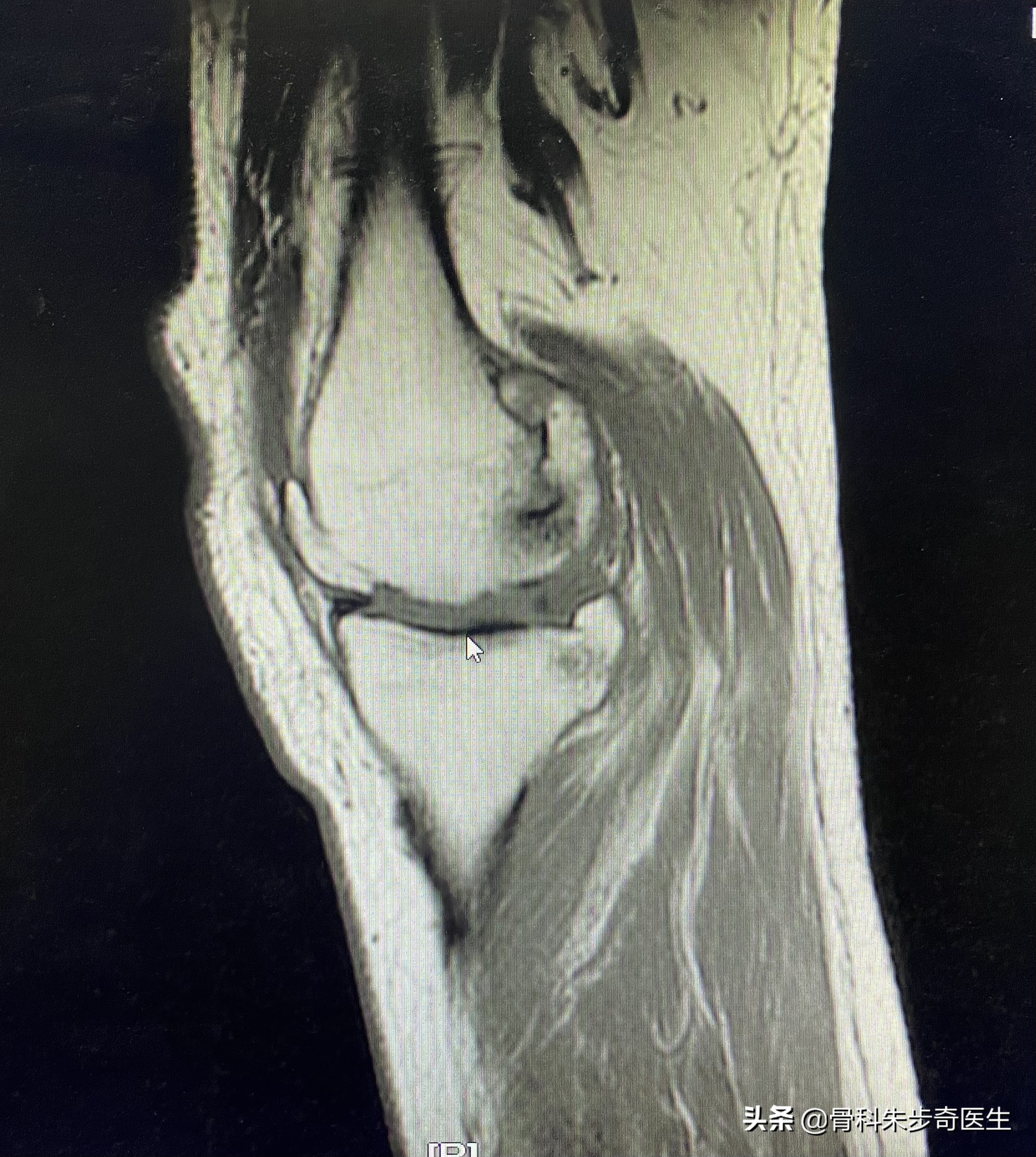 膝关节有骨刺应该怎么治,早期膝关节有骨刺怎么能治愈