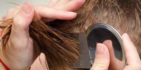 怎么去除头上的虱子和虱子卵,头上长虱子有什么办法除掉虱子