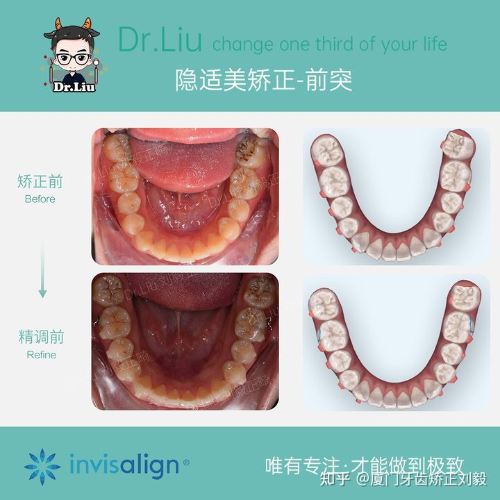 正畸临床拔牙矫治,拔牙正畸矫正嘴凸案例