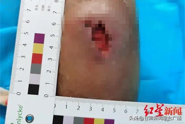 男子被虫子咬后腿肿了,小伙子被蚊虫咬了得了病