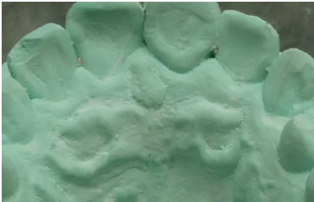 口腔内壁凹凸不平图片,口腔内壁凹凸不平褶皱