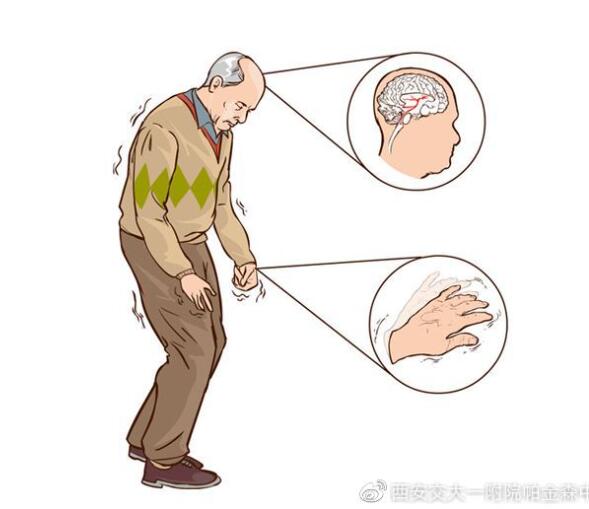 帕金森病人吃了药老是恶心怎么办,帕金森吃完了药还抖怎么办