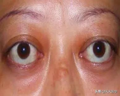 甲状腺功能亢进症用药物治疗,甲状腺亢进吃什么中成药好得快