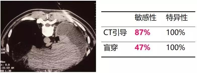 ct引导下穿刺活检诊断的分析,超声引导下穿刺活检什么样子的呢